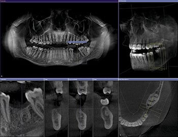 Digital Dental Xrays