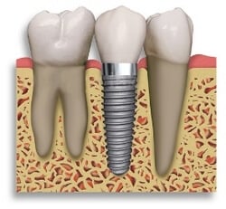 Dental Implants