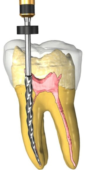 Root Canal Therapy